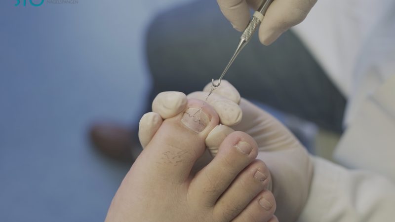 ingrown-toenail-g2ea847b74_1920-romah24